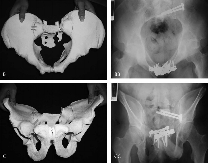 Table Skeletal Fixation in Pelvic Ring Reduction